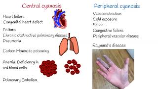 Cyanosis Symptoms and Causes Central and Peripheral Cyanosis [upl. by Eillas]