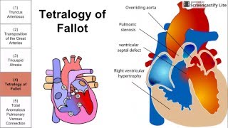 Cyanotic Congenital Heart Diseases [upl. by Enej]