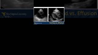 Pericardial Effusion vs Fat Pad emergencymedicine POCUS echo echofirst FOAMed FOAMus [upl. by Reehsab]