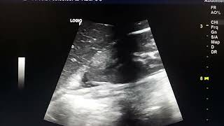 pyelonephritis ultrasound findings [upl. by Jacynth]