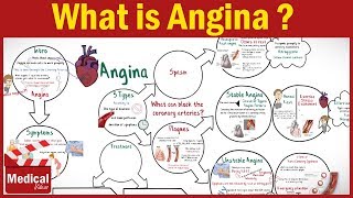 Pharmacology  What is Angina Pectoris  Types of Angina Symptoms Causes ampTreatment FROM A TO Z [upl. by Stilla577]