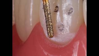 Minimally Invasive Ceramic Restorations [upl. by Mazlack753]