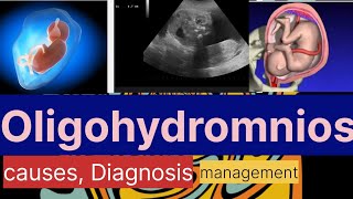 Oligohydramnios causes Diagnosismanagement Dr Naima Bano [upl. by Temirf]