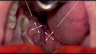 Grade 4 Tonsils with Dr Soroush Zaghi at The Breathe Institute  Pre and Post airway CBCT [upl. by Hairym]