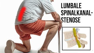 Lumbale Stenose  Spinalkanalstenose [upl. by Shippee]