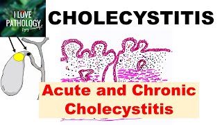 CHOLECYSTITIS Acute and Chronic Pathology and Complications [upl. by Mayfield]