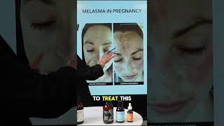 The pregnancy mask shorts melasma [upl. by Vladamar966]