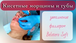 Заполнение кисетных морщин филлером Belotero Soft и увеличение губ [upl. by Adnilre216]