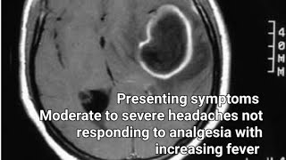 Brain abscess [upl. by Macdonell]