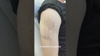 Laser tattoo removal results lasertattooremoval beforeandafter skincare tattoos satisfying [upl. by Amity]