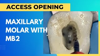 Maxillary Molar Access Opening with MB2 [upl. by Oilcareh]