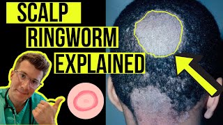 Doctor explains Scalp Ringworm Tinea Capitis including causes symptoms treatment amp more [upl. by Eelinej854]