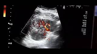 Pyelonephritis Focal acute pyelonephritisultrasound medicine mbbs doctor [upl. by Drofla]