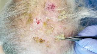 Debulking Lesions on the Scalp Erosive Pustulosis of the Scalp  CONTOUR DERMATOLOGY [upl. by Aidul]