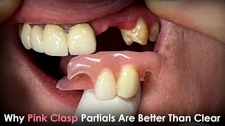 Why Pink Clasp Partials Are Better Than Clear Clasp Partials [upl. by Asuncion57]