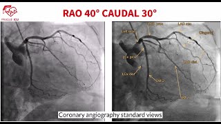 Coronary angiography standard views [upl. by Kilk]