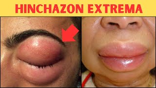 Angioedema que se hereda Síntomas y tratamiento [upl. by Katzman663]