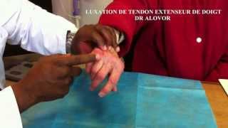 LUXATION DU TENDON EXTENSEUR DE LANNULAIRE [upl. by Dena]