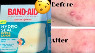 IT WORKED Testing out HydroSeal Bandaids for acne [upl. by Anerhs]