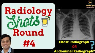 Pneumoperitoneum Why a chest radiograph is preferred over abdominal radiograph All 4 reasons [upl. by Keir]