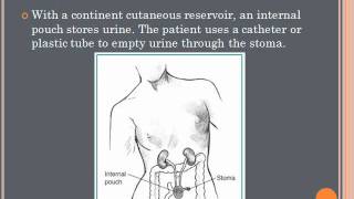 Urinary Diversions Presentation [upl. by Donald]