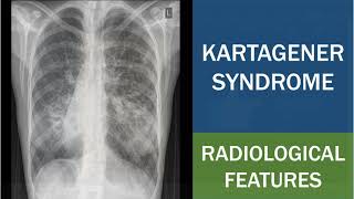 Kartagener Syndrome  Primary Ciliary Dyskinesia  Situs Inversus  Chest Xray [upl. by Ahsilahs993]