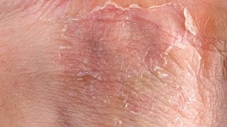 Eczema GRAPHIC Fast Outbreak Treatment Options  Eczema Dermatitis Rash Treatment 2015 [upl. by Egedan]