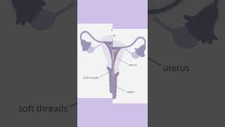 Copper T IUD side effects coppert iud cramping contraceptivemethod heavybleeding vomiting [upl. by Saravat]