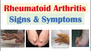 Rheumatoid Arthritis RA Signs amp Symptoms amp Associated Complications [upl. by Sankey]