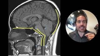 Chiari Malformation amp Cervical Instability a Deep Dive  Upper Cervical Chiropractor Spokane [upl. by Anidualc]