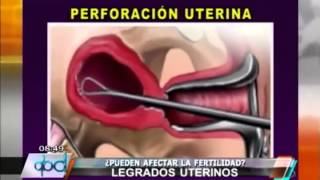 PROCREAR ¿Los legrados uterinos afectan la fertilidad [upl. by Araz169]