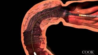 Evolution® Duodenal ControlledRelease Stent  Uncovered Animation [upl. by Eneg392]