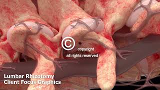 Lumbar Rhizotomy Animation [upl. by Alor698]