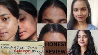 Azelaic Acid Cream 10  Aziderm Cream  Honest Review  Remove Pigmentation  Acne  Dark Sports [upl. by Bozovich492]