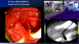 ERCP for acute cholangitis [upl. by Asirem]