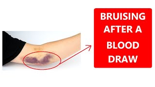 BRUISING AND SWELLING AFTER A BLOOD DRAW  DONT BE AFRAID [upl. by Nevin]