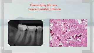 Omneya Wahba Odontogenic Tumors 3 [upl. by Nuy137]