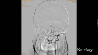 Rupture of vertebral artery dissection aneurysm during 3D DSA [upl. by Jinny561]