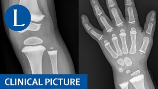 Metaphyseal sclerosis in a child with a giant cell tumour treated with denosumab [upl. by Swann]