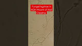 Septate Fungal hyphae in KOH Mount of Nail Clipping [upl. by Esyahc]