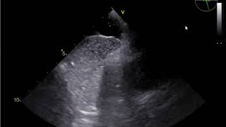 Estudo com microbolhas para avaliar aneurisma do septo interatrial na busca de shunt DE [upl. by Gregson]