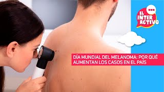 Melanoma la importancia de los controles dermatológicos tempranos [upl. by Hofstetter]