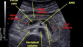 How to measure Pancreas on ultrasoundPancreas ultrsound [upl. by Atsilac]