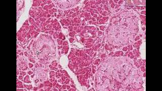 Histopathology Pancreas Type 2 Diabetes mellitus [upl. by April778]