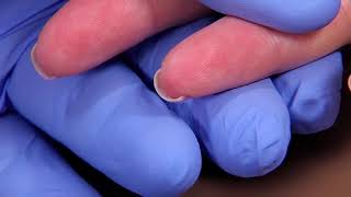 Perform a Capillary Puncture Obtain a Blood Sample by Capillary Puncture [upl. by Minny997]