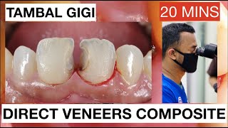 Step by Step Direct Veneers Composite Anterior Multiple Cases 20mins  General Dentist Griya RR [upl. by Etterrag]