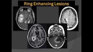 Brain Scans Lord of the Ring Enhancing Lesions 101 [upl. by Aimahs]