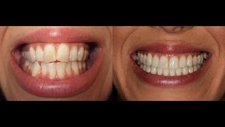 Invisalign Time Lapse UPDATED [upl. by Ahtnahc]