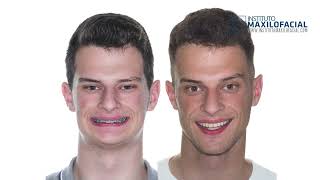 Jaw surgery Case  105 Gustavo  Short face overbite maxilomandibular retrusion [upl. by Nanice]