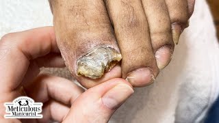 Tips to Treat Nail Fungus at Home [upl. by Kubiak784]